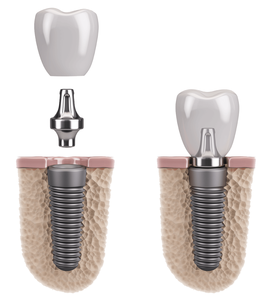 Stages Of Dental Implant Treatment