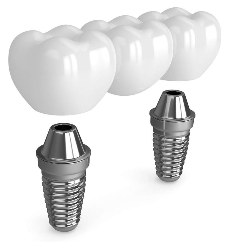 Why See Royal Dental Care For Dental Implants?