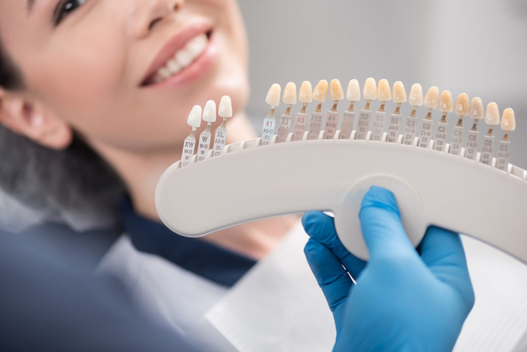 Durathin No-Prep Veneers