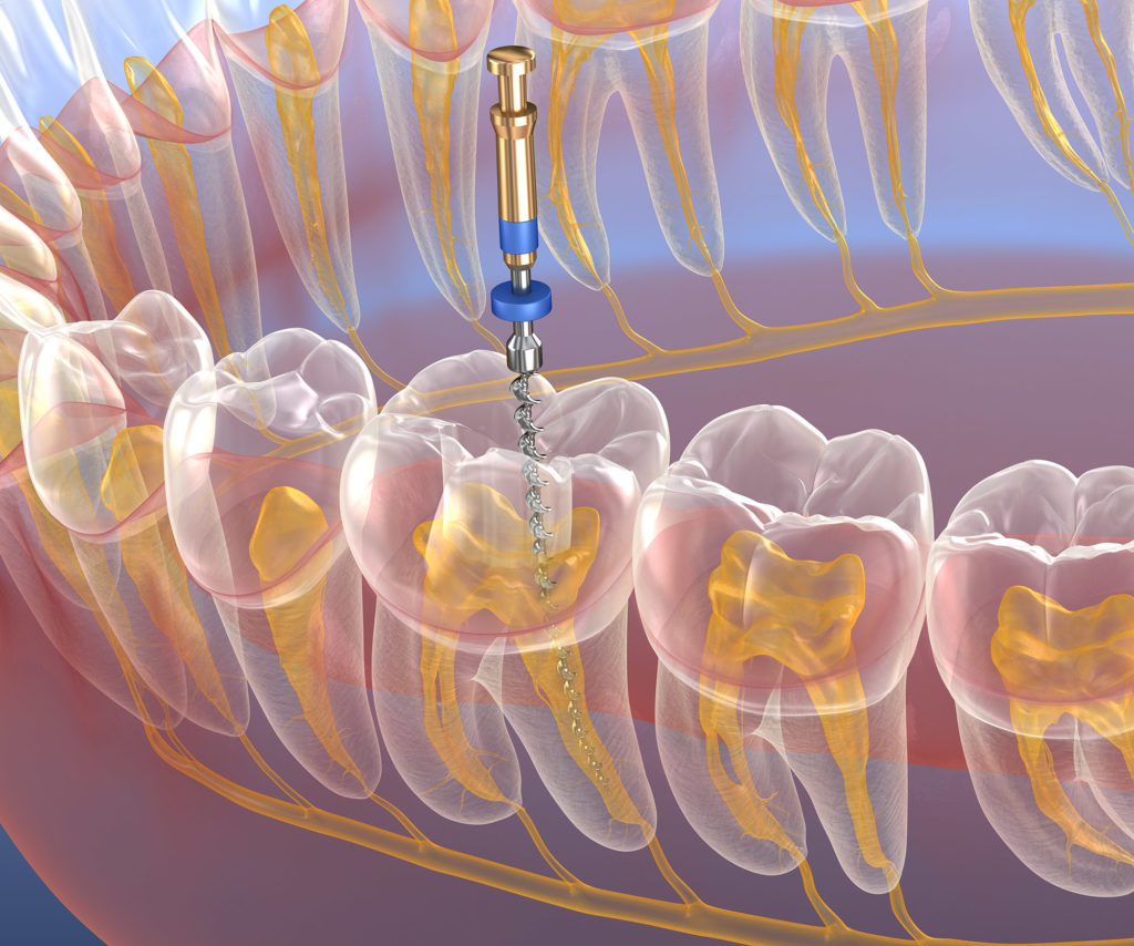 Why Root Canal Therapy Is Necessary
