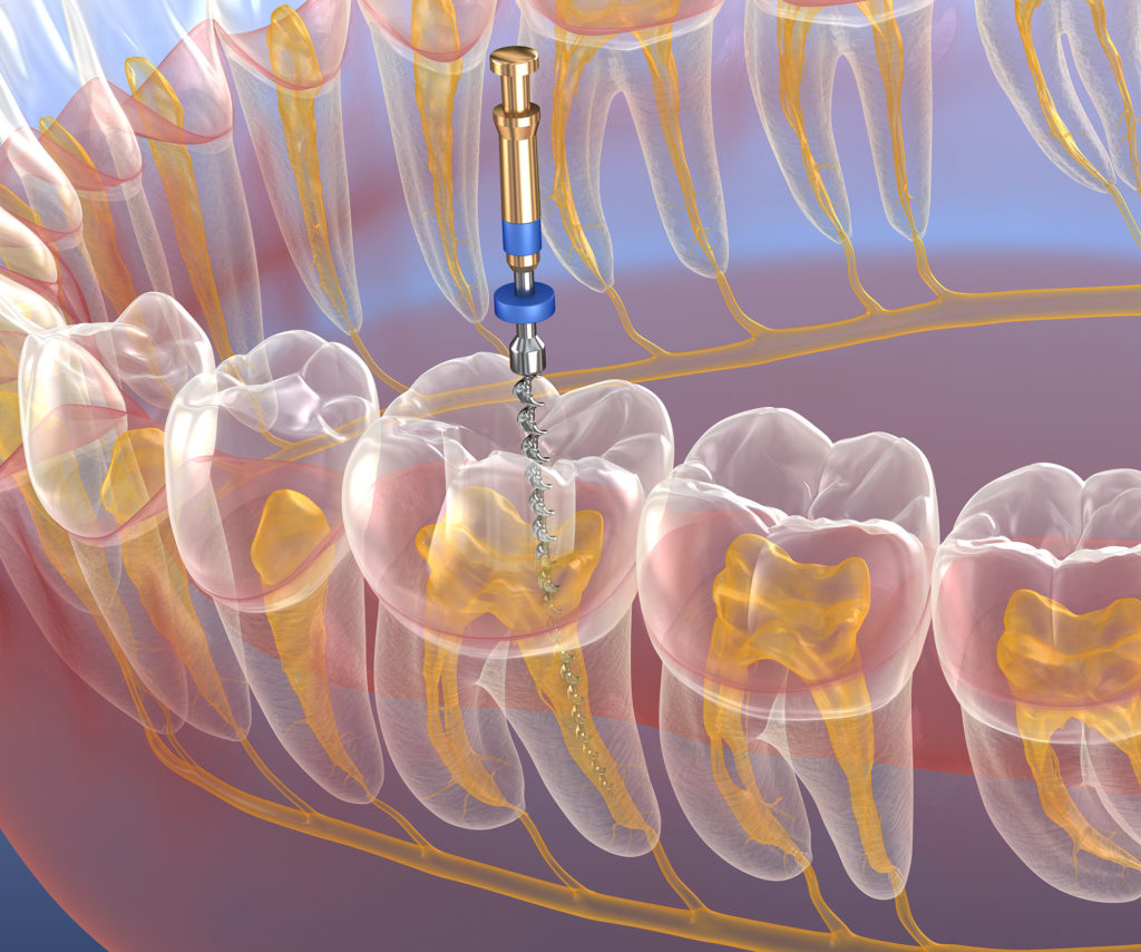 Root Canals
