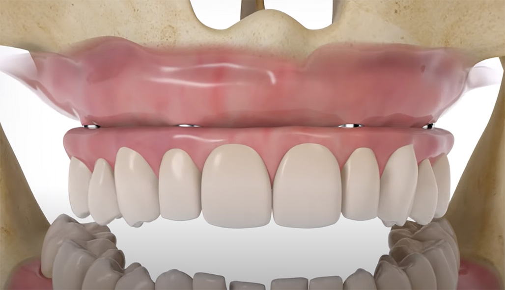 All-on-4® treatment concept | Nobel Biocare