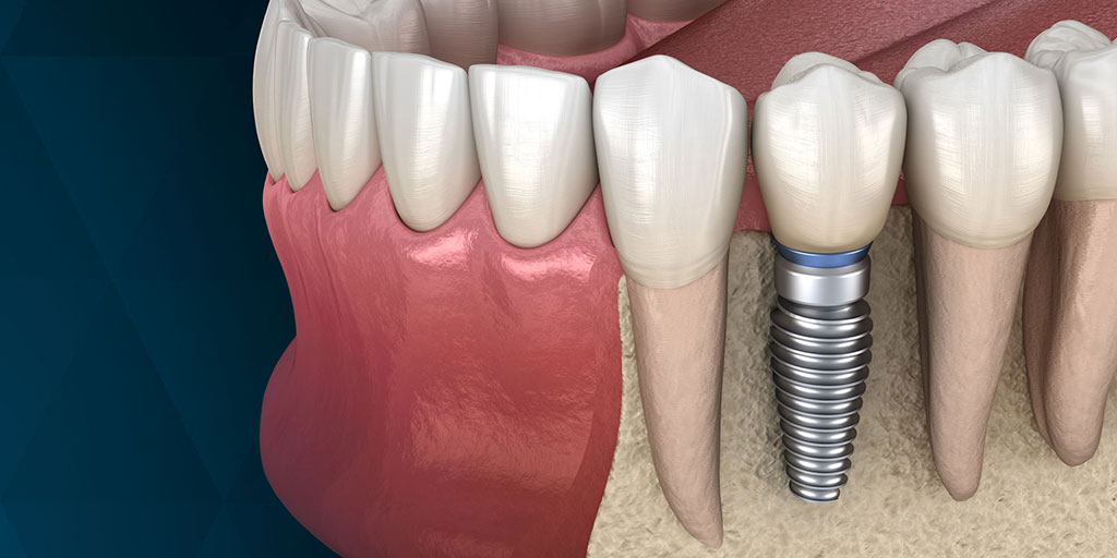 Why Dental Implants Are Worth The Investment