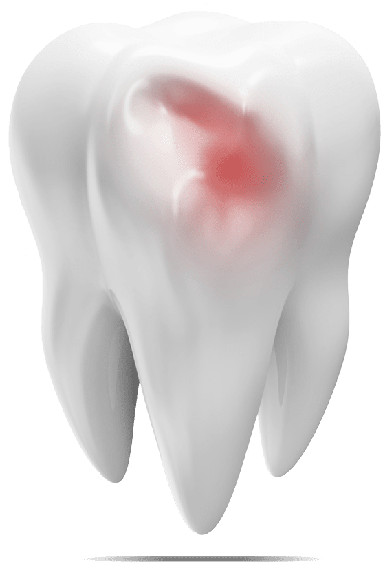 Tooth removal