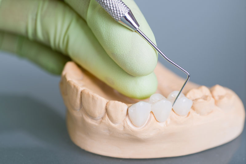 enefits Of Dental Crowns