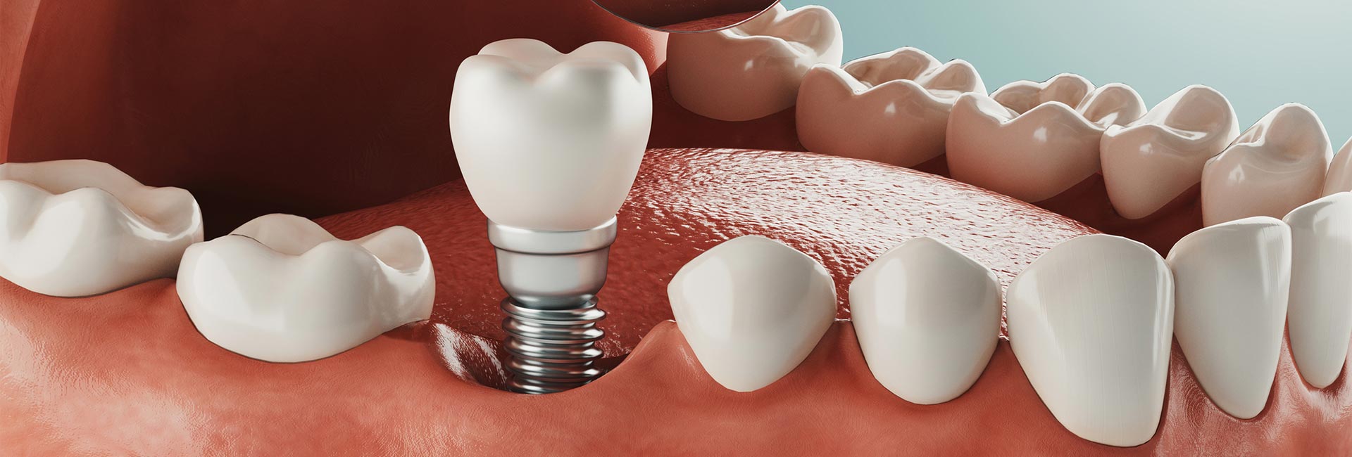 Dental Implants