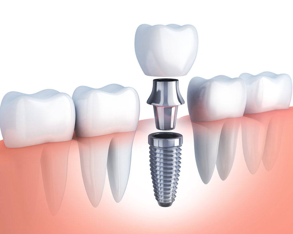 Types Of Dental Implants