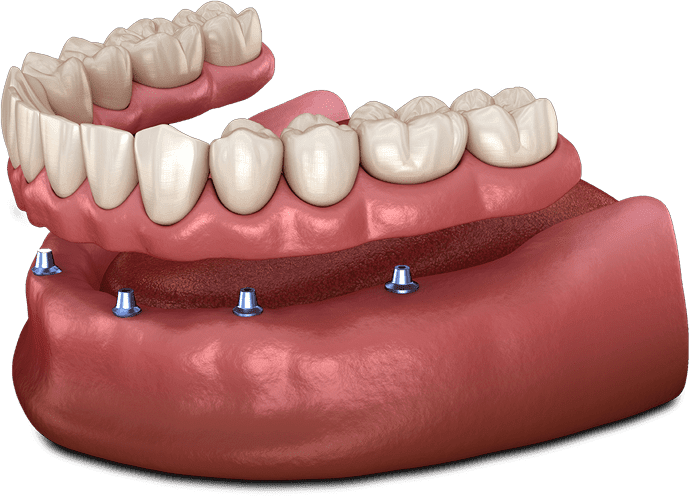 Implant Supported Dentures Model