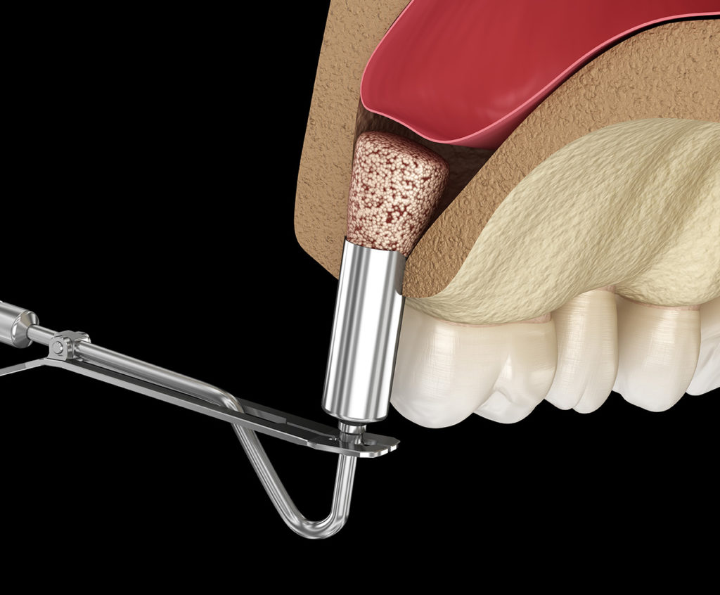 Sinus Lift & Bone Graft