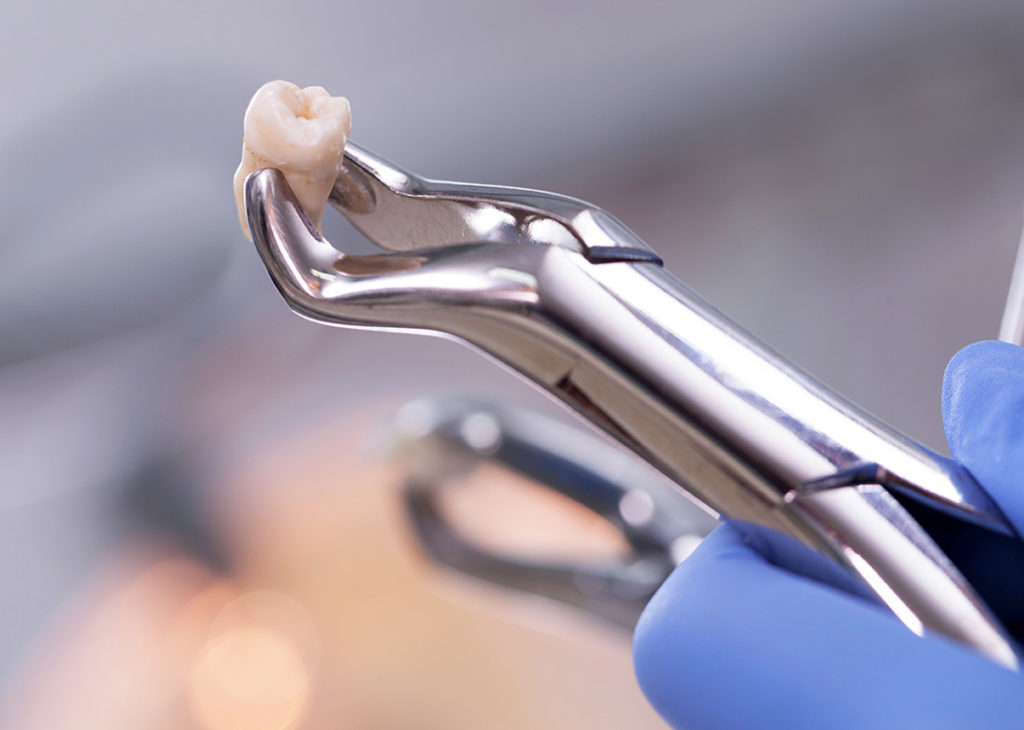 Tooth Extractions photo with dental instrument
