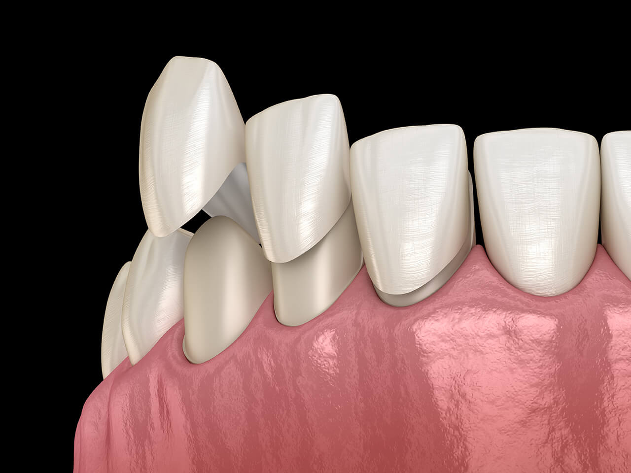 Traditional Porcelain Veneers