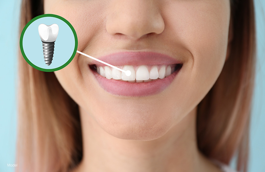 closeup of woman's smile with implanted teeth